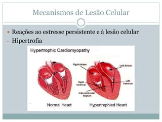Mecanismos de Lesão Celular
 Reações ao estresse persistente e à lesão celular
- Hipertrofia
 