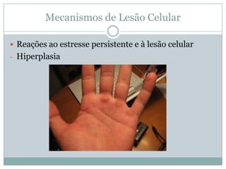 Mecanismos de Lesão Celular
 Reações ao estresse persistente e à lesão celular
- Hiperplasia
 
