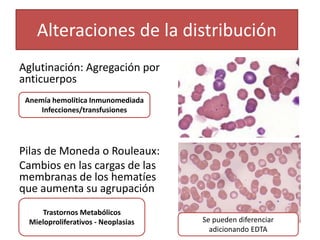 Alteraciones de la distribución
Aglutinación: Agregación por
anticuerpos
Pilas de Moneda o Rouleaux:
Cambios en las cargas de las
membranas de los hematíes
que aumenta su agrupación
Anemía hemolítica Inmunomediada
Infecciones/transfusiones
Trastornos Metabólicos
Mieloproliferativos - Neoplasias Se pueden diferenciar
adicionando EDTA
 
