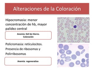 Alteraciones de la Coloración
Hipocromasia: menor
concentración de hb, mayor
palidez central
Policromasia: reticulocitos.
Presencia de ribosomas y
Polirribosomas
Anemia- Def de Hierro.
Coloración
 