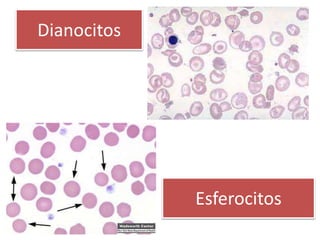 Dianocitos
Esferocitos
 