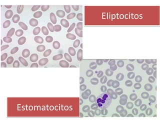 EIiptocitos
Estomatocitos
 