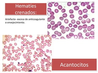 Hematíes
crenados:
Artefacto- exceso de anticoagulante
o envejecimiento.
Acantocitos
 