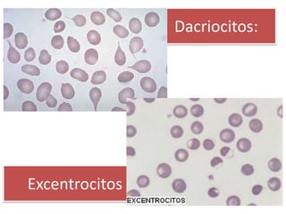 Dacriocitos:
Excentrocitos
 