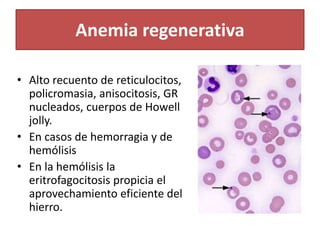 Anemia regenerativa
• Alto recuento de reticulocitos,
policromasia, anisocitosis, GR
nucleados, cuerpos de Howell
jolly.
• En casos de hemorragia y de
hemólisis
• En la hemólisis la
eritrofagocitosis propicia el
aprovechamiento eficiente del
hierro.
 