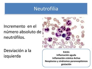 Neutrofilia
Incremento en el
número absoluto de
neutrófilos.
Desviación a la
izquierda
Estrés
Inflamación aguda
Inflamación crónica Activa
Neoplasias y síndromes paraneoplásicos
gestación
 