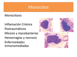 Monocitos
Monocitosis
Inflamación Crónica
Postraumáticos
Micosis y mycobacterias
Hemorragias y necrosis
Enfermedades
inmunomediadas
 