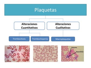 Alteraciones
Cualitativas
Alteraciones
Cuantitativas
Trombocitosis Trombocitopenia Macroplaquetas
Plaquetas
 