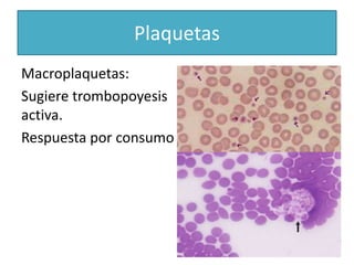 Macroplaquetas:
Sugiere trombopoyesis
activa.
Respuesta por consumo
Plaquetas
 