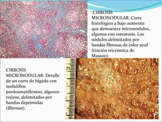 CIRROSIS
MICRONODULAR. Detalle
de un corte de hígado con
nodulillos
pardoamarillentos, algunos
rojizos, delimitados por
bandas deprimidas
(fibrosas).
CIRROSIS
MICRONODULAR. Corte
histológico a bajo aumento
que demuestra micronódulos,
algunos con esteatosis. Los
nódulos delimitados por
bandas fibrosas de color azul
(tinción tricrómica de
Masson).
 