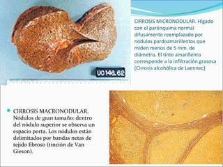 CIRROSIS MICRONODULAR. Hígado
con el parénquima normal
difusamente reemplazado por
nódulos pardoamarillentos que
miden menos de 5 mm. de
diámetro. El tinte amarillento
corresponde a la infiltración grasosa
(Cirrosis alcohólica de Laennec)
 CIRROSIS MACRONODULAR.
Nódulos de gran tamaño: dentro
del nódulo superior se observa un
espacio porta. Los nódulos están
delimitados por bandas netas de
tejido fibroso (tinción de Van
Gieson).
 