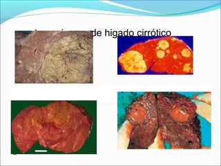 Hepatocarcinoma de higado cirrótico
•
 