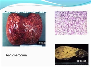 Colangiocarcinoma hepático
Angiosarcoma
 