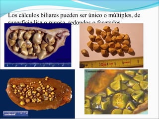 Los cálculos biliares pueden ser único o múltiples, de
superficie lisa o rugosa, redondos o facetados
 