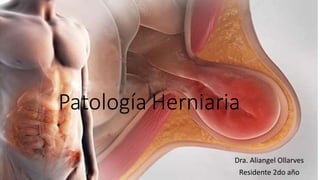Patología Herniaria
Dra. Aliangel Ollarves
Residente 2do año
 