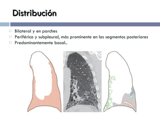 Distribución Bilateral y en parches Periférico y subpleural, más prominente en los segmentos posteriores Predominantemente basal.. 
