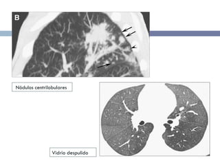 Nódulos centrilobulares Vidrio despulido 
