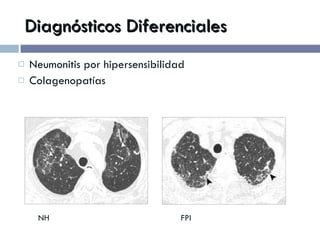 Diagnósticos Diferenciales Neumonitis por hipersensibilidad Colagenopatías NH   FPI 