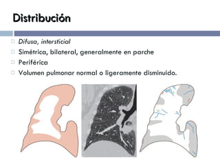 Distribución Difusa, intersticial Simétrica, bilateral, generalmente en parche Periférica  Volumen pulmonar normal o ligeramente disminuido. 