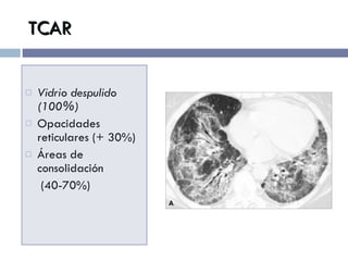 TCAR Vidrio despulido (100%) Opacidades reticulares (+ 30%) Áreas de consolidación   (40-70%) 
