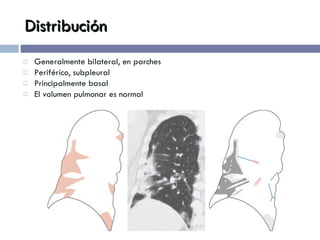 Distribución Generalmente bilateral, en parches Periférico, subpleural Principalmente basal El volumen pulmonar es normal 