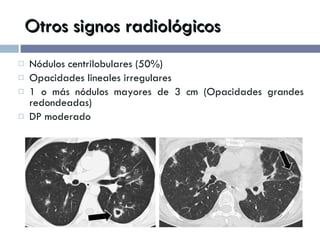 Otros signos radiológicos Nódulos centrilobulares (50%) Opacidades lineales irregulares 1 o más nódulos mayores de 3 cm (Opacidades grandes redondeadas) DP moderado 