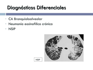Diagnósticos Diferenciales CA Bronquioloalveolar Neumonía eosinofílica crónica NSIP NSIP 