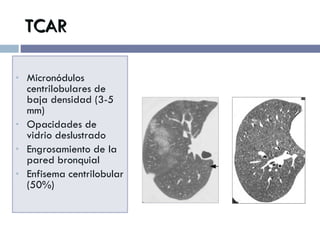 TCAR Micronódulos centrilobulares de baja densidad (3-5 mm)  Opacidades de vidrio deslustrado Engrosamiento de la pared bronquial Enfisema centrilobular (50%) 