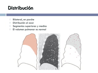 Distribución Bilateral, en parche Distribución al azar Segmentos superiores y medios El volumen pulmonar es normal 