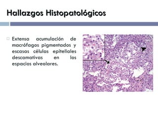 Hallazgos Histopatológicos Extensa acumulación de macrófagos pigmentados y escasas células epiteliales descamativas en los espacios alveolares. 