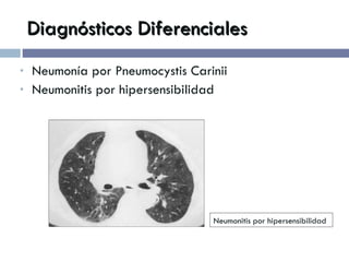 Diagnósticos Diferenciales Neumonía por Pneumocystis Carinii Neumonitis por hipersensibilidad Neumonitis por hipersensibilidad 