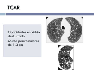 TCAR Opacidades en vidrio deslustrado Quiste perivasculares de 1-3 cm  