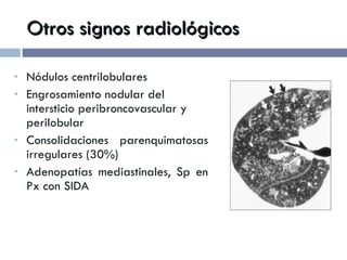 Otros signos radiológicos Nódulos centrilobulares Engrosamiento nodular del intersticio peribroncovascular y perilobular  Consolidaciones parenquimatosas irregulares (30%) Adenopatías mediastinales, Sp en Px con SIDA 