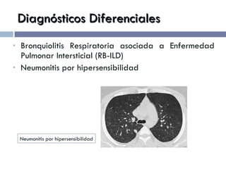 Diagnósticos Diferenciales Bronquiolitis Respiratoria asociada a Enfermedad Pulmonar Intersticial (RB-ILD) Neumonitis por hipersensibilidad Neumonitis por hipersensibilidad 