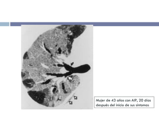 Mujer de 43 años con AIP, 20 días después del inicio de sus síntomas 
