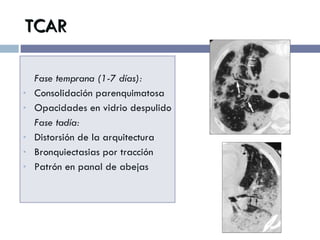 TCAR Fase temprana (1-7 días): Consolidación parenquimatosa Opacidades en vidrio despulido Fase tadía: Distorsión de la arquitectura Bronquiectasias por tracción Patrón en panal de abejas 
