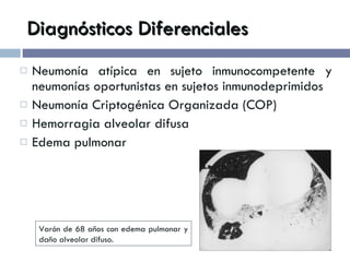 Diagnósticos Diferenciales Neumonía atípica en sujeto inmunocompetente y neumonías oportunistas en sujetos inmunodeprimidos Neumonía Criptogénica Organizada (COP) Hemorragia alveolar difusa Edema pulmonar Varón de 68 años con edema pulmonar y daño alveolar difuso. 