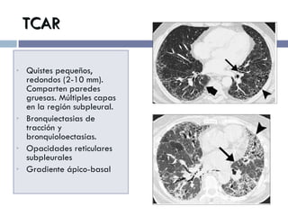 TCAR Quistes pequeños, redondos (2-10 mm). Comparten paredes gruesas. Múltiples capas en la región subpleural. Bronquiectasias de tracción y bronquioloectasias. Opacidades reticulares subpleurales Gradiente ápico-basal 