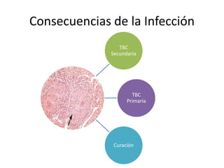 Consecuencias de la Infección
TBC
Secundaria
TBC
Primaria
Curación
 