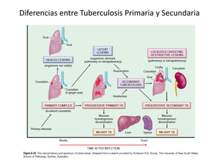 Diferencias entre Tuberculosis Primaria y Secundaria
 