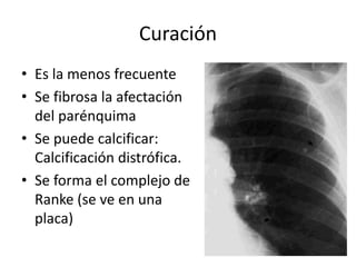 Curación
• Es la menos frecuente
• Se fibrosa la afectación
del parénquima
• Se puede calcificar:
Calcificación distrófica.
• Se forma el complejo de
Ranke (se ve en una
placa)
 
