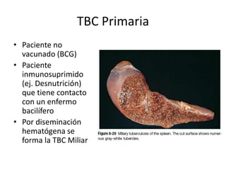 TBC Primaria
• Paciente no
vacunado (BCG)
• Paciente
inmunosuprimido
(ej. Desnutrición)
que tiene contacto
con un enfermo
bacilífero
• Por diseminación
hematógena se
forma la TBC Miliar
 