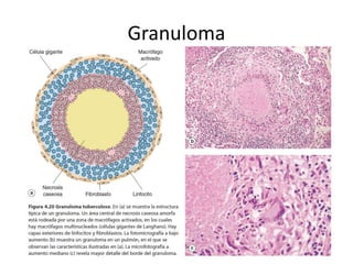 Granuloma
 