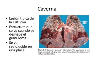 Caverna
• Lesión típica de
la TBC 2ria
• Estructura que
se ve cuando se
deshace el
granuloma
• Se ve
radiolucido en
una placa
 