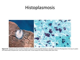 Histoplasmosis
 
