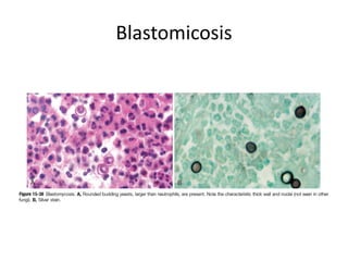 Blastomicosis
 