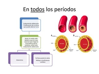 En todos los períodos
Endoarteritis obliterante:
Proliferación de la intima
que puede obstruir la luz
Aorta: la media cede
debido a que los vasa
vasorum que irrigan la
musculatura que la
sostiene, sufren esta
endoarteritis obliterante.
Aneurisma
Se lleva puesta la valva:
Reflujo e insuficiencia
cardíaca
 