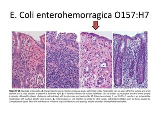 E. Coli enterohemorragica O157:H7
 