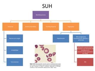 SUH
Manifestaciones
Síntomas
Diarrea con sangre
Irritabilidad
Convulsiones
Anemia hemolítica Trombocitopenia Angiopatia
Hipertensión
Microangiopatia
trombotica de capilares y
arteriolas
Activación excesiva de las
plaquetas con formación de
trombos en la
microirculacion (ppalente
en riñón)
IRA
 