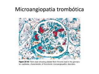 Microangiopatia trombótica
 